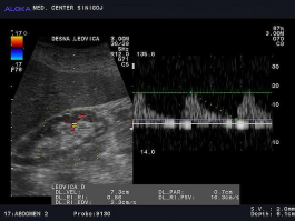 Ultrazvok ledvic - kronična parenhimska okvara ledvice, povišan RI